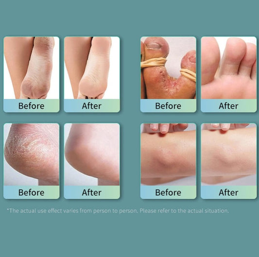 Lansiyi Advanced Foot Hygiene & Fungal Protection Spray | 20ml Glow