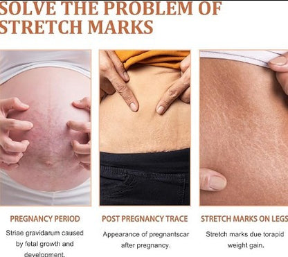 EELHOE Stretch Mark Repair & Prevention Cream | 45g Eelhoe